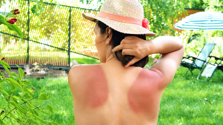 A lady with a sunburned back 