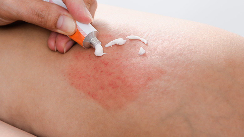 applying cooling cream on bites