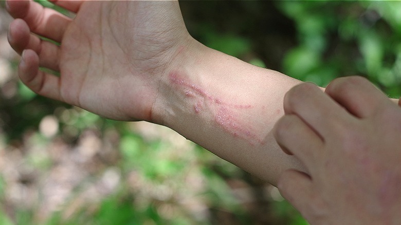 Person scratching rash