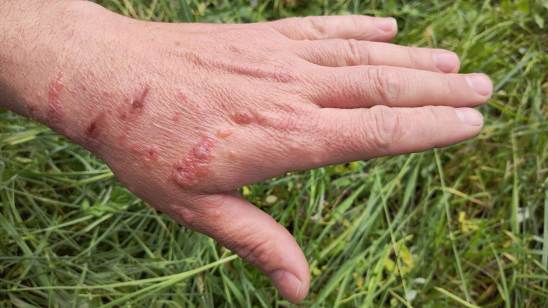 Hand showing wild parsnip burns