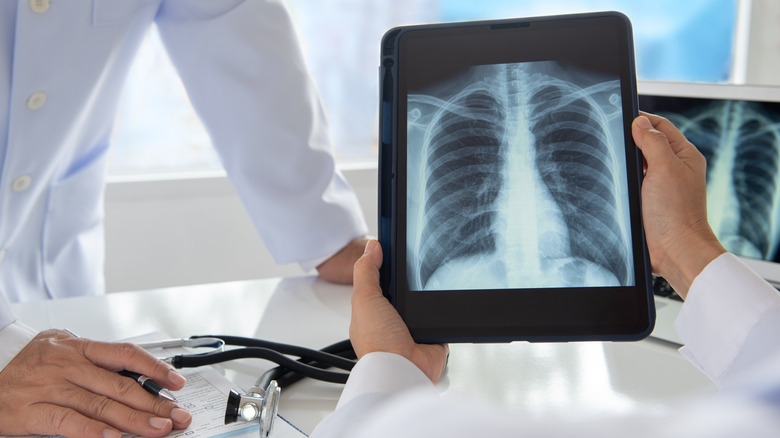 lungs on x-ray chart