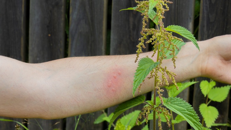 Arm with stinging nettle rash