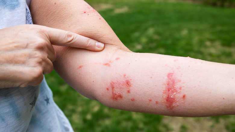 person with poison ivy rash