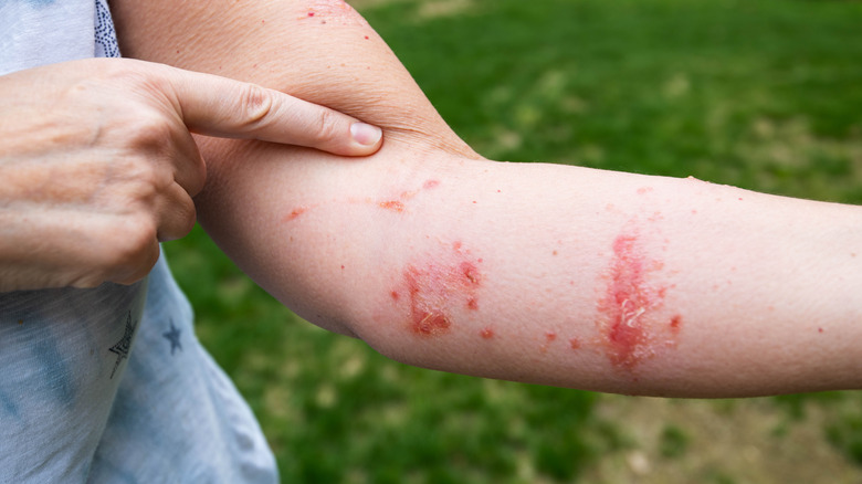 arm with poison ivy rash