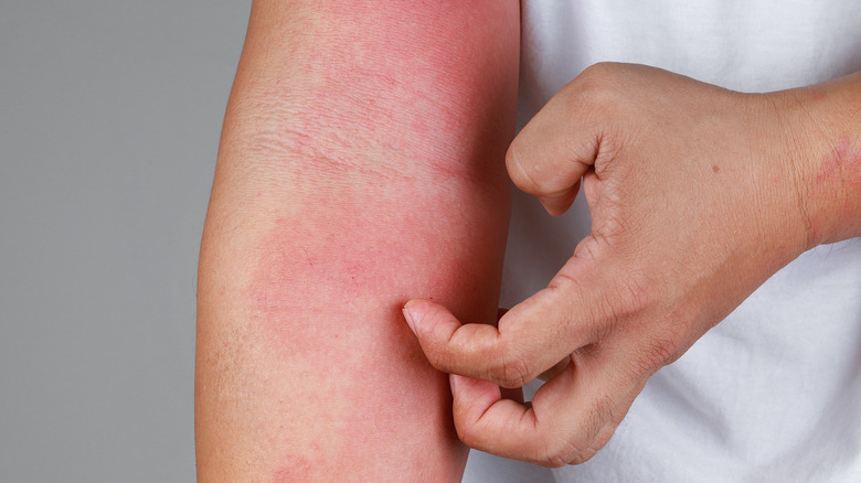 skin irritation on arm